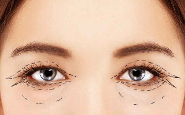 Eyelid Surgery